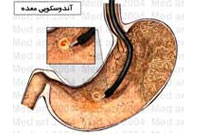 شيوه انجام آندوسکوپي