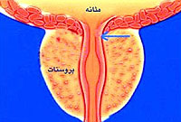 پروستات، علایم و درمان