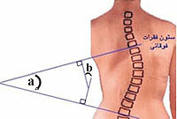 خمیدگی غیر طبیعی ستون مهره ها ( اسکولیوز(