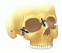 شکستگی و آسیب صورت در ورزش ( Facial fracture )