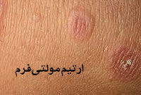 اريتم‌ مولتي‌فرم‌ Erythema multiforme