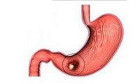 افزايش آمار سرطان معده در ايران