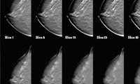 ماموگرافي به چه دردي مي‌خورد؟