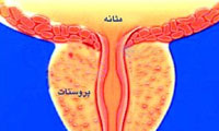 آقايان سرطان پروستات را جدي بگيرند