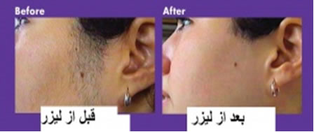 قبل از ليزر پوست بخوانيد قبل از ليزر پوست بخوانيد