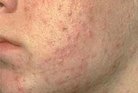 آكنه؛ شناخت و شيوه هاي درمان (1)