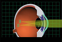 آستیگماتیسم