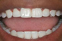 آشنایی با انواع روکش دندان