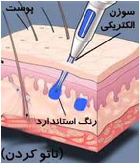 تاتو ؛ درمانگری يا ويرانگری ؟!