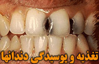 تغذيه و پوسیدگی دندانها