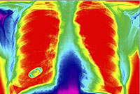 آمفيزم‌(Emphysema)