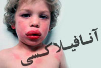 آنافيلاكسي‌ (شوك‌ آلرژيك‌)(Anaphylaxis)
