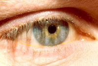 بلفاريت‌ (blepharitis)