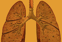 بلاستوميكوز(Blastomycosis)