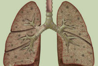 برونشكتازي‌ (bronchiectasis)