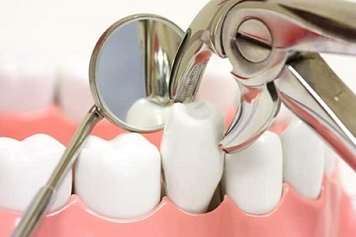 Закаленный зуб. Хирургическая стоматология. Хирургическая стоматология зубов.