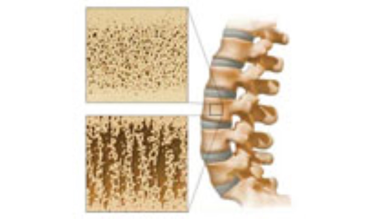 Вторичный остеопороз. Остеопороз костей позвоночника. Остеопороз позвоночника l1-l4. Здоровая кость и остеопороз. Постхирургический остеопороз.