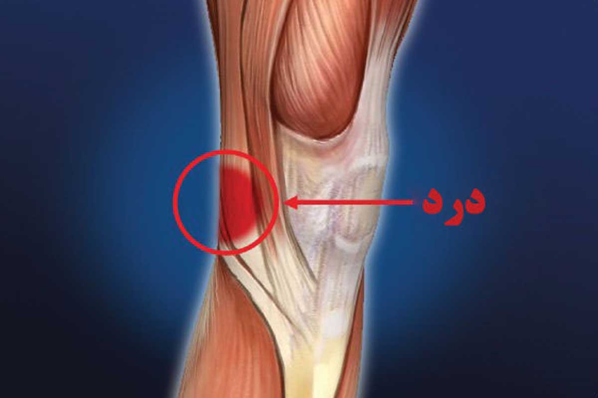 Сильные боли при разгибании колена. Подколенная мышца коленного сустава. Тендинит сухожилия подколенной мышцы. Киста сухожилия подколенной мышцы. Сухожилие на сгибе колена.