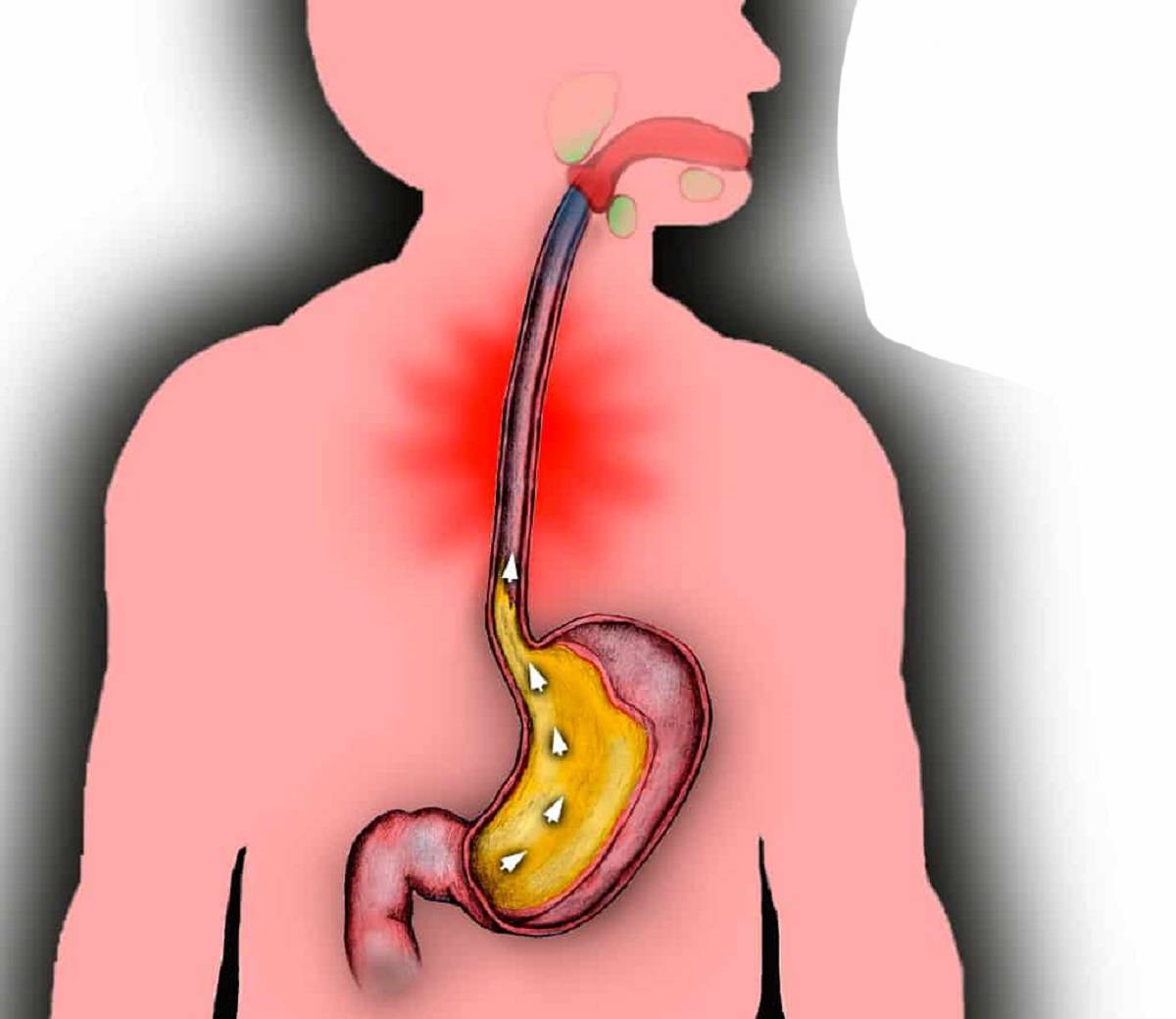 Заброс кислоты из желудка в пищевод