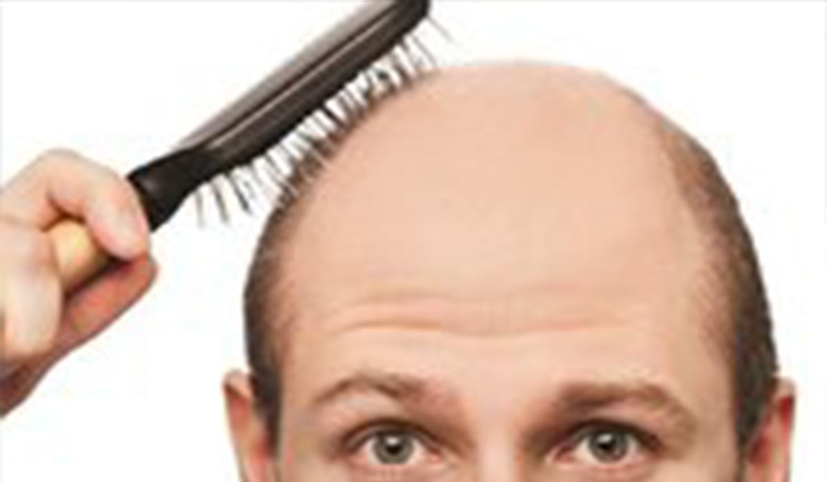 درمان ریزش موی ارثی!