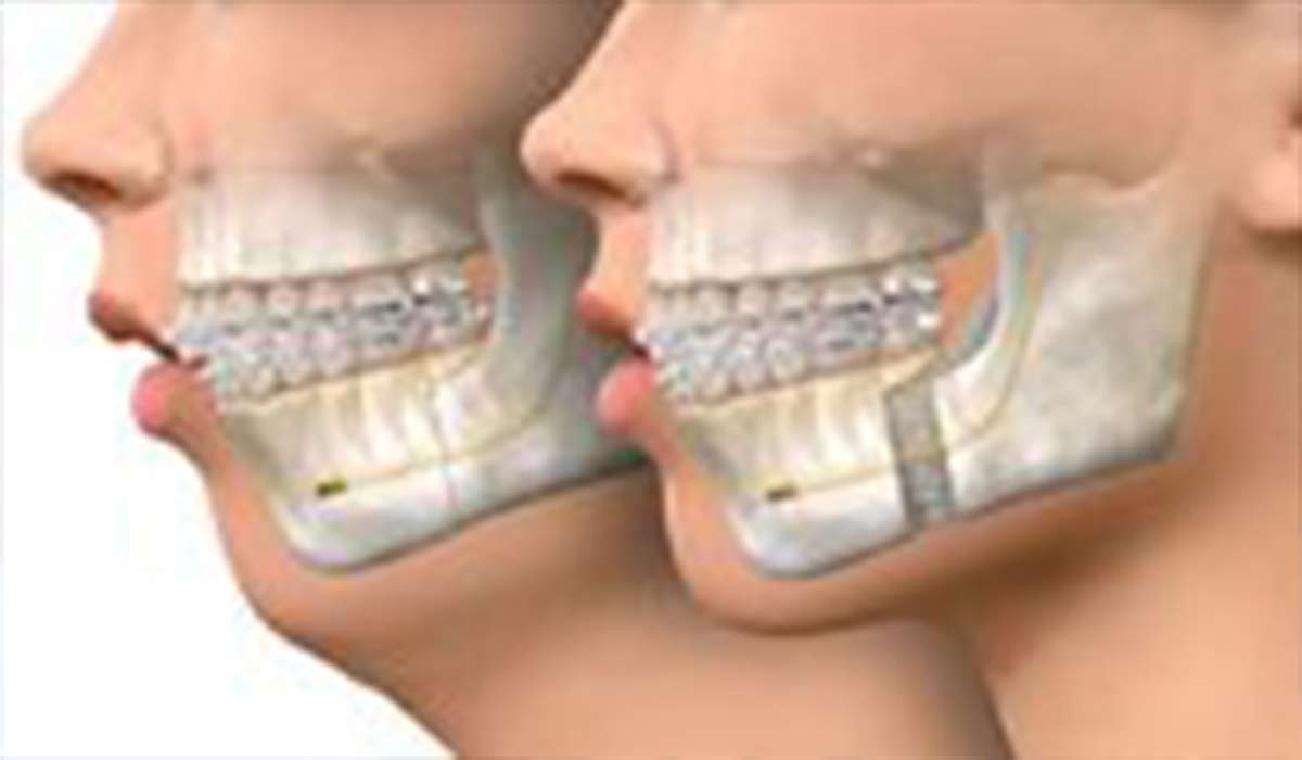 مراحل انجام جراحی فک چگونه است؟