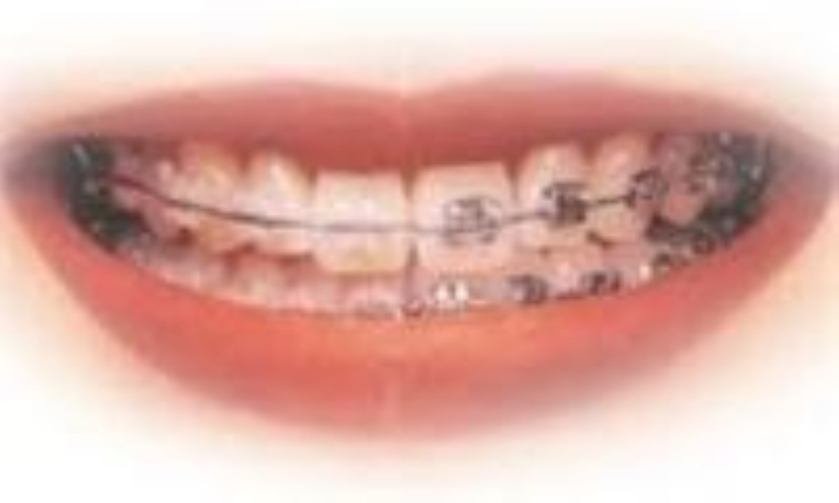 ارتودنسی پیشگیرانه برای جلوگیری از دندان‌های فاصله‌دار