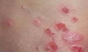 عفونتهای قارچی پوست: علائم و درمان