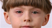 علائم عارضه چشم صورتی در نوزادان و کودکان تازه به راه افتاده چیست؟