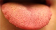 بررسی برخی علل زردی روی زبان
