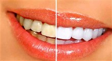 علت زردی دندان ها و رفع آن