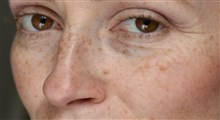 لکه های پوستی، علل و روشهای درمان آن