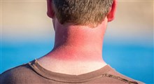 علل و درمان آفتاب سوختگی