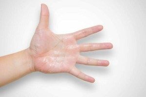 13 روش برای درمان عرق کردن دست وپا