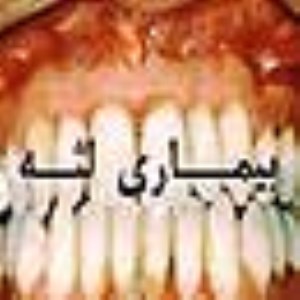 بيماريهاي لثه ونسوج نگهدارنده دندانها (periodontitis)