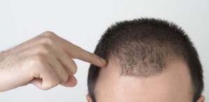 ریزش مو در مردان جوان به چه علت می باشد؟