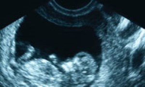يک بارداري چند سونوگرافي مي‌خواهد؟