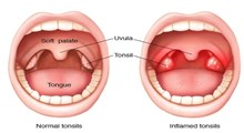 آشنایی با التهاب یا ورم لوزه Tonsillitis به همراه علائم و راه‌های درمان آن