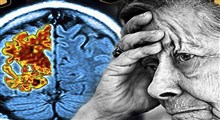 علت و علائم بیماری آلزایمر و روشهای درمان دارویی