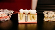 مراقبت بعد از ایمپلنت دندان: مسواک زدن، تغذیه و مراجعه به دندانپزشک
