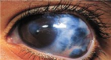 حقایقی درباره بیماری چشم به نام آب سیاه