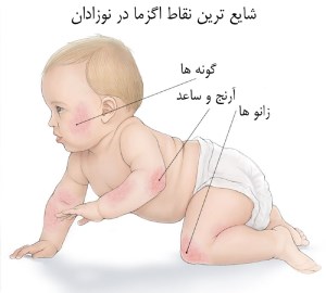 علت و درمان اگزما در نوزادان چیست؟