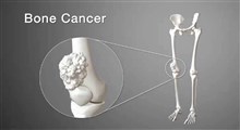 سرطان استخوان، نشانه ها، علل، تشخیص و درمان آن