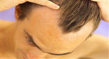 انواع ریزش موی سر و علل و عوامل آن