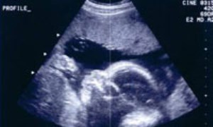 سونوگرافي در سه ماهه اول بارداري 