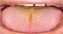 دلایل زرد شدن زبان و ارتباط آن با سایر بیماری ها