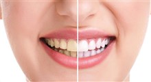 آشنایی با علل زرد شدن دندان ها و چگونگی رفع آن