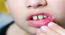 راهکارهایی برای درمان آفت‌ دهان کودک