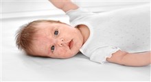حساسیت نوزاد به شیر چگونه تشخیص داده می شود؟