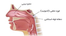 از علت تا درمان آدنوئید یا لوزه سوم