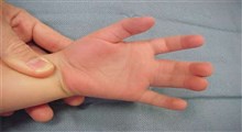 علت سین داکتیلی یا به هم چسبیدگی انگشتان دست و پا راه های درمان آن
